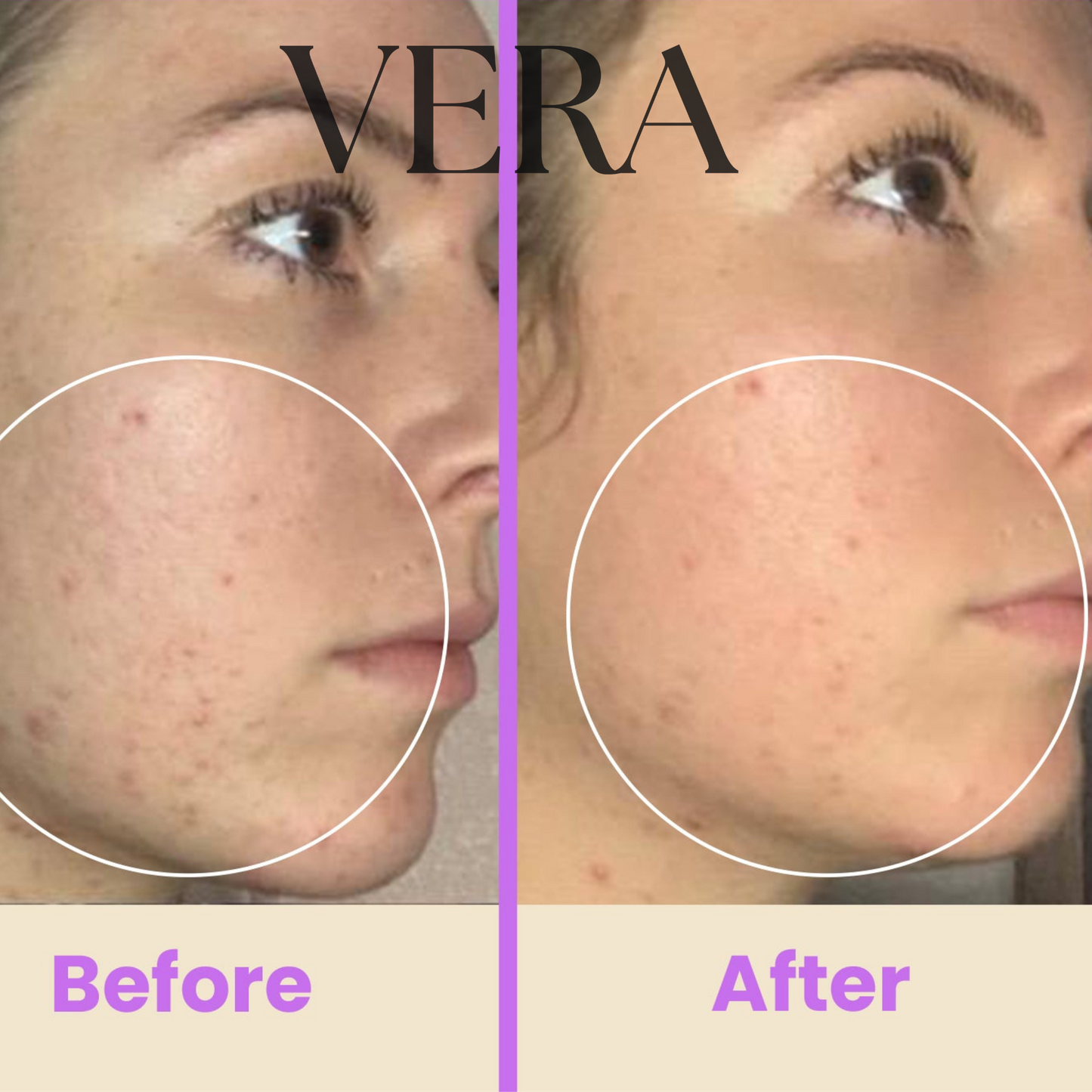 VERA High Frequency Glow Wand