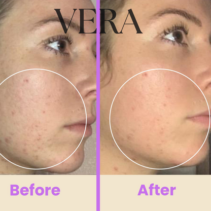 VERA High Frequency Glow Wand