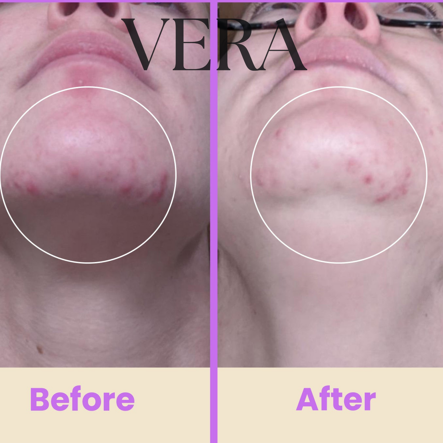 VERA High Frequency Glow Wand